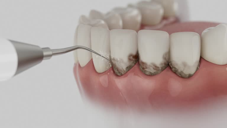 Trusted Wisdom Tooth Removal service in Camdenton, MO - Dentist Open Now